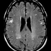 Axial FLAIR in the same patient shows additional subcortical white matter hyperintensities .