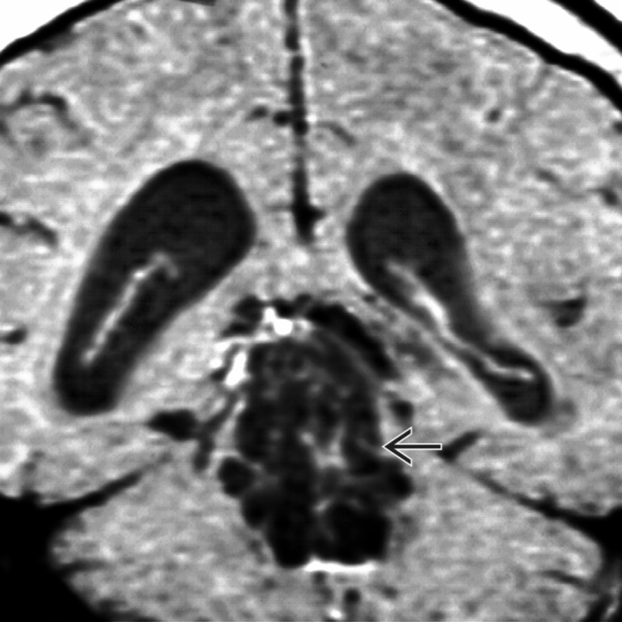 Coronal T1 C+ MR shows neurocysticercosis involvement within the 3rd ventricle and aqueduct , causing IVOH. The lateral ventricles are dilated.