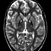 Dystonia prompted repeat MR 4 years later. Axial T2WI MR shows that the "eyes" have diminished in size and intensity with greater surrounding pallidal hypointensity. Volume loss is now evident, particularly frontal.