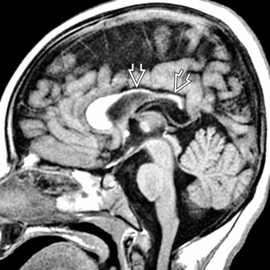 Midline sagittal T1 MR shows thinning  of the body & splenium of the corpus callosum following neonatal parietooccipital ischemia & gliosis from a combination of hypoxic ischemic encephalopathy & hypoglycemia.