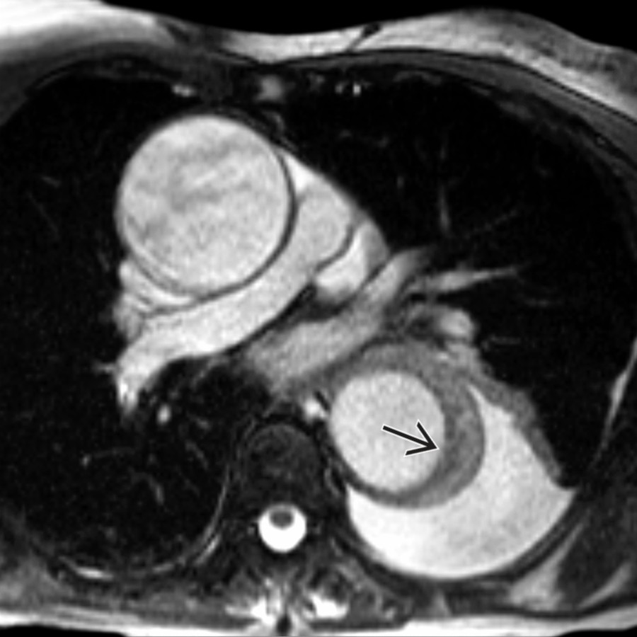 Axial SSFP MR in the same patient shows that the IMH  is iso- to slightly hyperintense when compared with adjacent muscles. MR is as efficient as CT in determining and characterizing the presence of IMH and may be used when CT is unavailable or contraindicated.