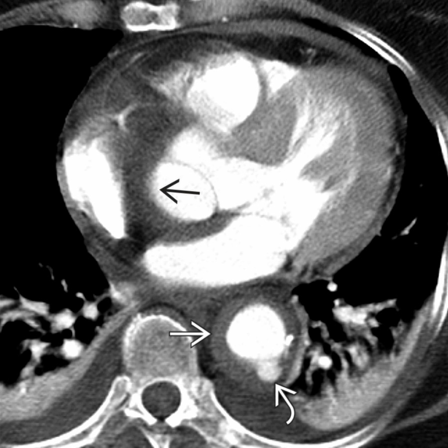 Axial chest CTA in the same patient shows concentric thickening along the ascending  and descending  thoracic aorta as well as a small IBP along the descending thoracic aorta . Note the small pericardial and bilateral pleural effusions, which are common nonspecific findings.