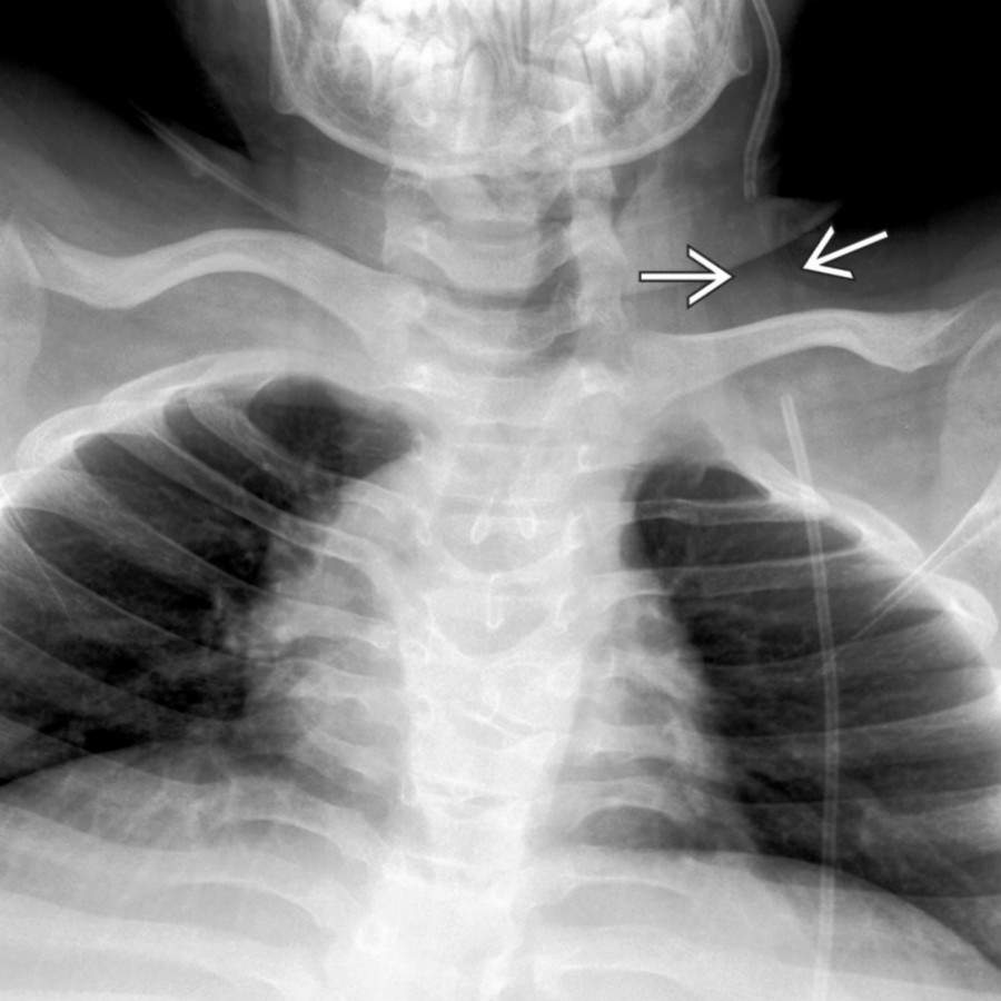 AP radiography in patient with a VP shunt and acute shunt failure reveals fractured shunt tubing .