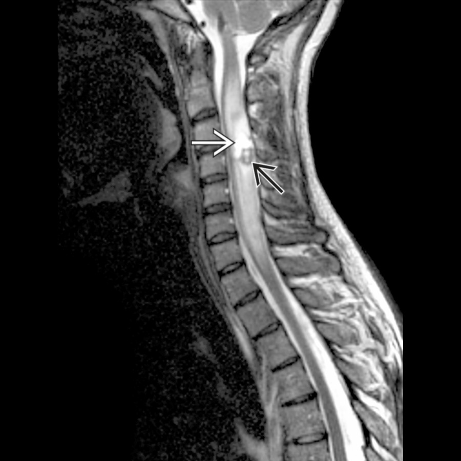 Sagittal T2 MR shows a nodular mass dorsally at the C4 level with a peripheral cyst . Syrinx enlarges the cord. The ring of hypointensity  suggests sequelae of hemorrhage.