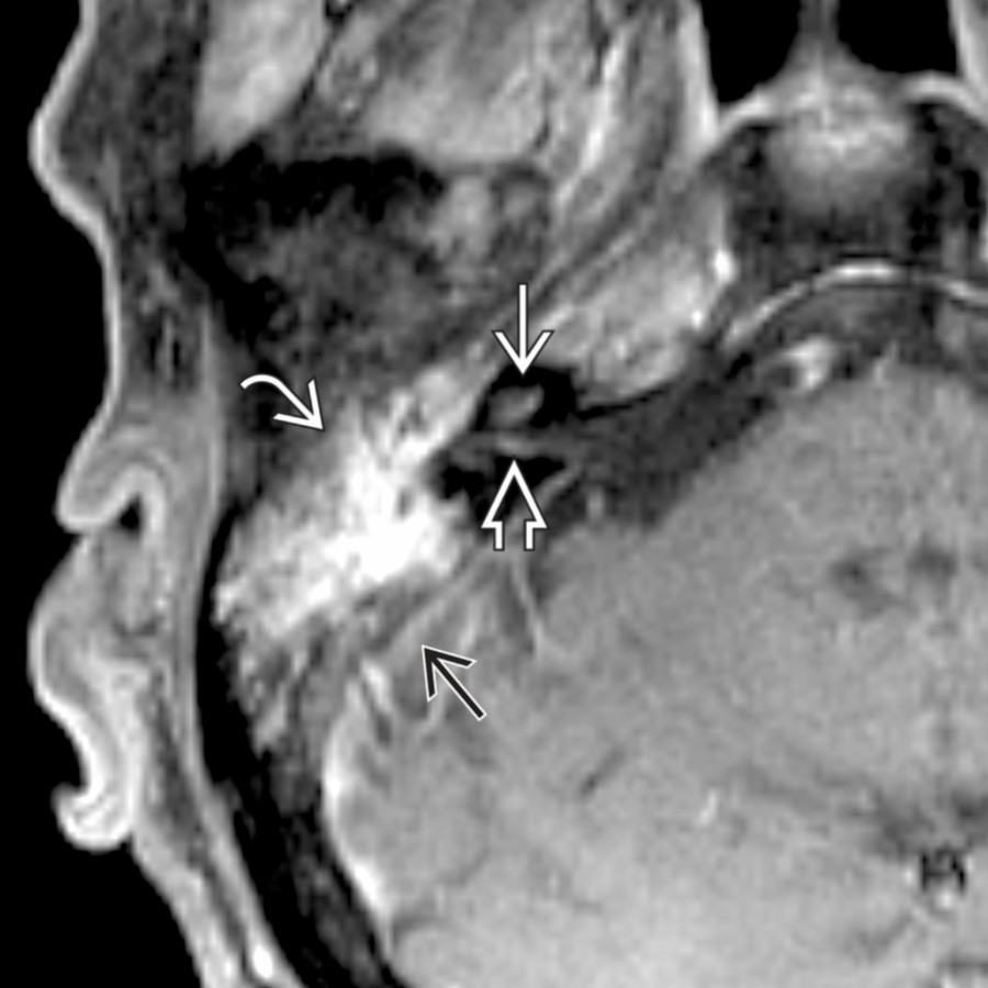 Axial T1 C+ FS MR in a patient with acute otomastoiditis complicated by labyrinthitis shows enhancement in the cochlea . There is additional vestibulocochlear neuritis with linear enhancement at the IAC fundus . Note enhancing mastoid/middle ear disease  and dural enhancement  due to marked inflammation.