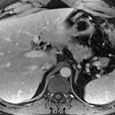 First of 2 axial T1 C+ MR images demonstrates the bilateral adrenal glands. At this level, the 2 limbs of each adrenal gland are not yet discretely visible.