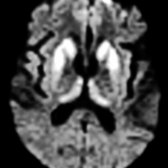 Axial DWI MR shows symmetric hyperintensity in the BG and thalami bilaterally. The thalamic involvement shows the "hockey stick" sign, which is symmetric pulvinar and dorsomedial thalamus hyperintensity. This sign is most commonly seen in vCJD but may also be present in sCJD, as in this case.