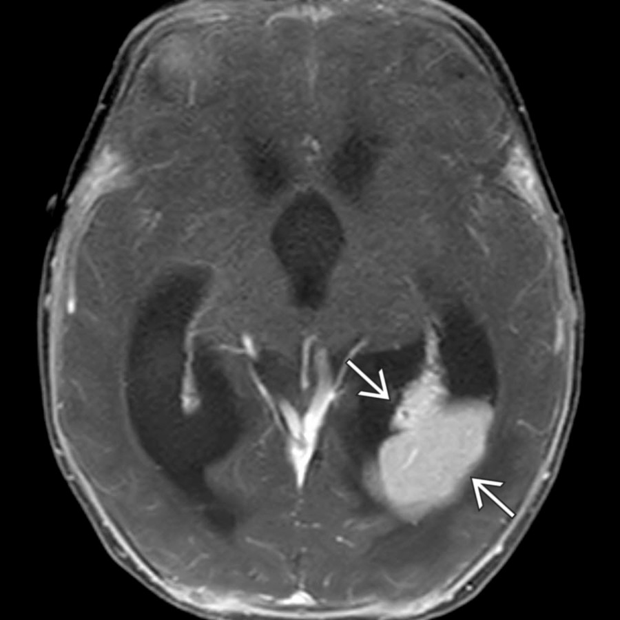 A papilloma of the choroid plexus in the occipital horn of the left lateral ventricle  causes moderate hydrocephalus by excessive CSF production in this 2-month-old.