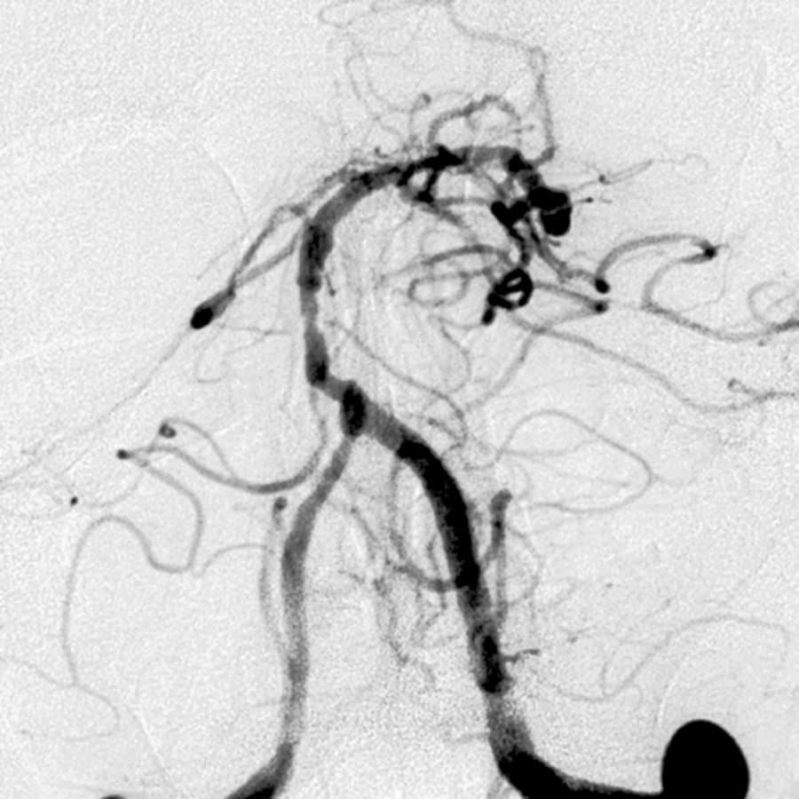Anteroposterior angiography shows multifocal stenoses characteristic for atherosclerosis, the most common cause of alternating stenoses and dilatations.