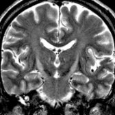 Coronal T2 MR in the same patient shows hyperintense signal along the bilateral corticospinal tract (CST) , more prominent in the internal capsule and cerebral peduncles.