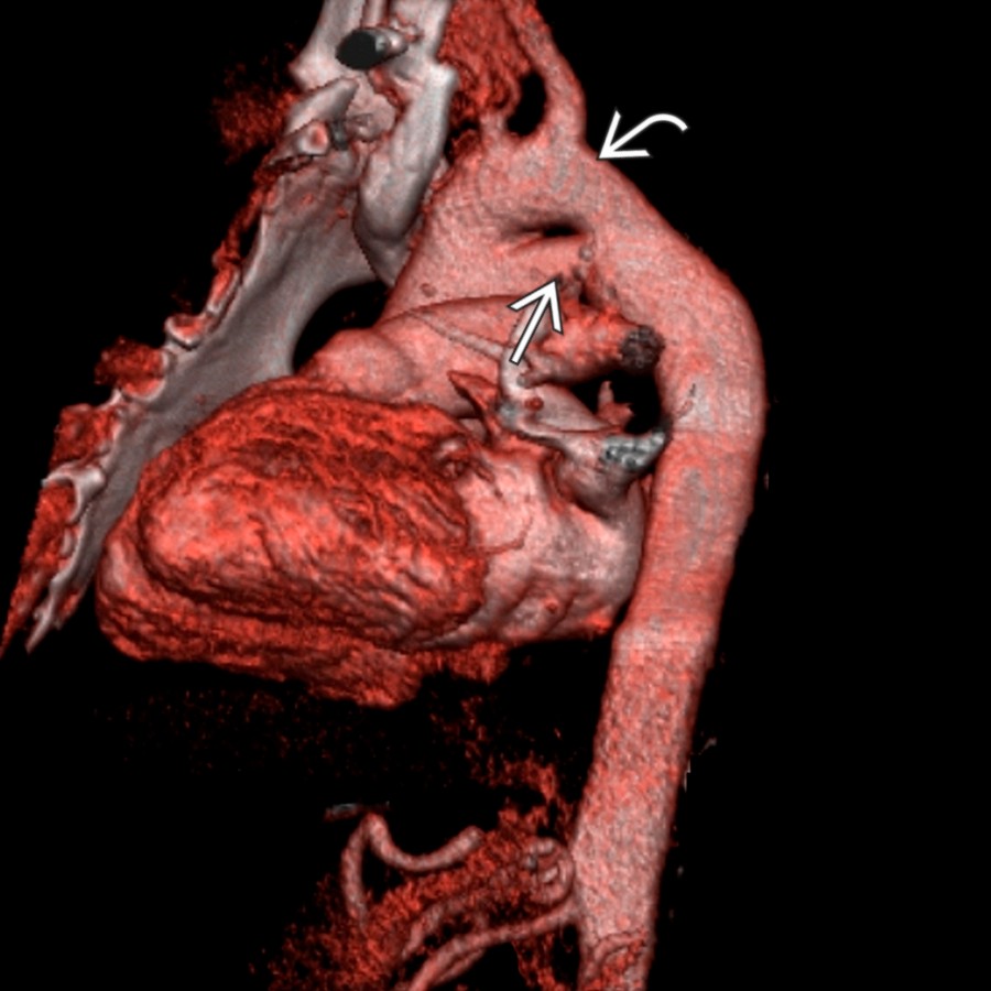 Oblique 3D volume-rendered reconstruction shows the relationship of the 4th arch  with the arch vessels. Note the abnormal persistent 5th arch  arising from the aorta at the level of the brachiocephalic trunk and reentering into the descending thoracic aorta at its isthmus.