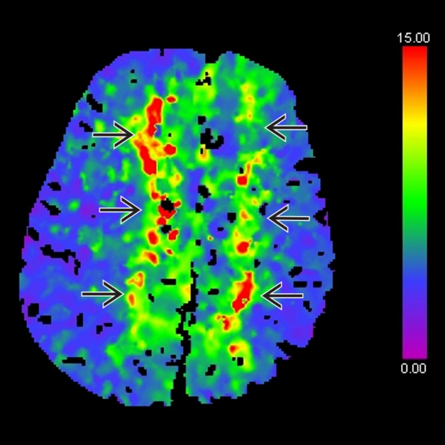 CT perfusion done after 4 days, axial time to drain (TTD) CT perfusion map generated using deconvolution algorithm (DC) shows abnormal increased TTD in bilateral parasagittal frontoparietal ACA territories .
