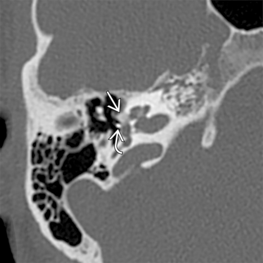 Axial bone CT shows a thick, lucent otosclerotic plaque anterior to the oval window  in the expected location of the fissula ante fenestram. An abnormal bulging convex contour is also noted due to the thickened bone. Stapes prosthesis is noted in the oval window .