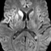 Axial DWI MR in a patient with sCJD shows asymmetric diffusion restriction in right BG  and cortex .