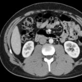 Axial correlative CECT better illustrates the anatomic relationships of the kidney with the posterior abdominal wall muscles. The kidney is lateral to the psoas muscle and rests upon the quadratus lumborum muscle. The erector spinae muscles are immediately posterior to the quadratus lumborum, and the 2 muscles are invested by the lumbodorsal fascia.