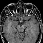 Axial T1WI C+ FS shows bright enhancement of the optic nerves , similar to the extraocular muscles, in a patient with MS and acute bilateral optic neuritis.