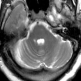 Axial T2 MR in the same patient shows volume loss with enlarged horizontal sulci in the contralateral cerebellar hemisphere . These findings are consistent with chronic CCD.