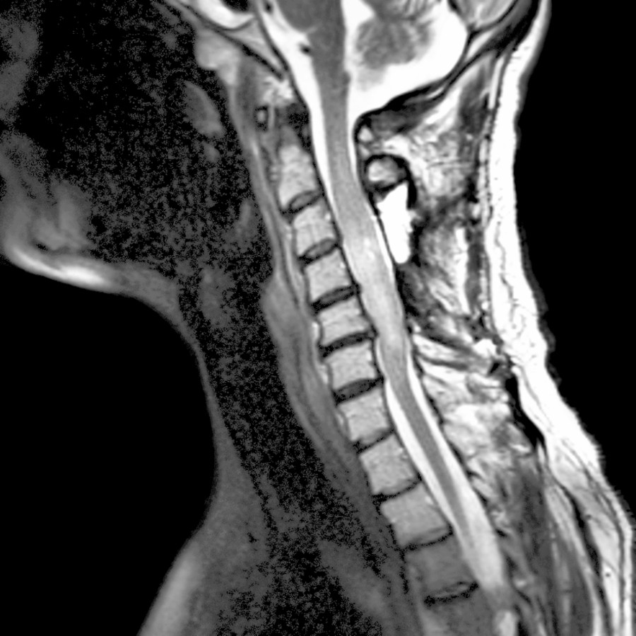 Sagittal T2 MR shows an infiltrative lesion expanding the midcervical cord. C3-C5 decompressive laminectomy has been performed.