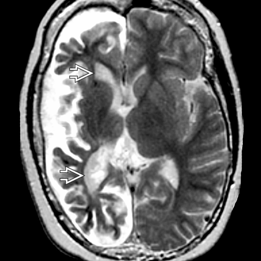 Axial T2 MR shows right hemiatrophy in Sturge-Weber syndrome. Chronic venous ischemia leads to progressive hemiatrophy. Note the ipsilateral large right ventricle  due to volume loss.