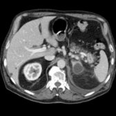 Axial CECT in a 72-year-old man with pancreatitis shows peripancreatic infiltration  and a 3-cm adrenal pseudocyst . The pseudocyst resolved on follow-up CT. Imaging surveillance is advocated for asymptomatic, probable pseudocysts.