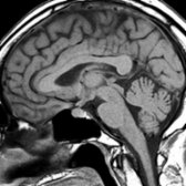 Sagittal T1 MR in a 53-year-old hypothyroid female patient shows a rounded, upwardly convex pituitary gland . The gland measured 12 mm in height.