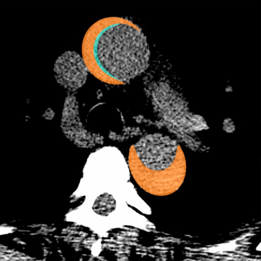 The orange overlay represents the hyperattenuating IMH. The light green overlay marks the thickened, atherosclerotic intima.