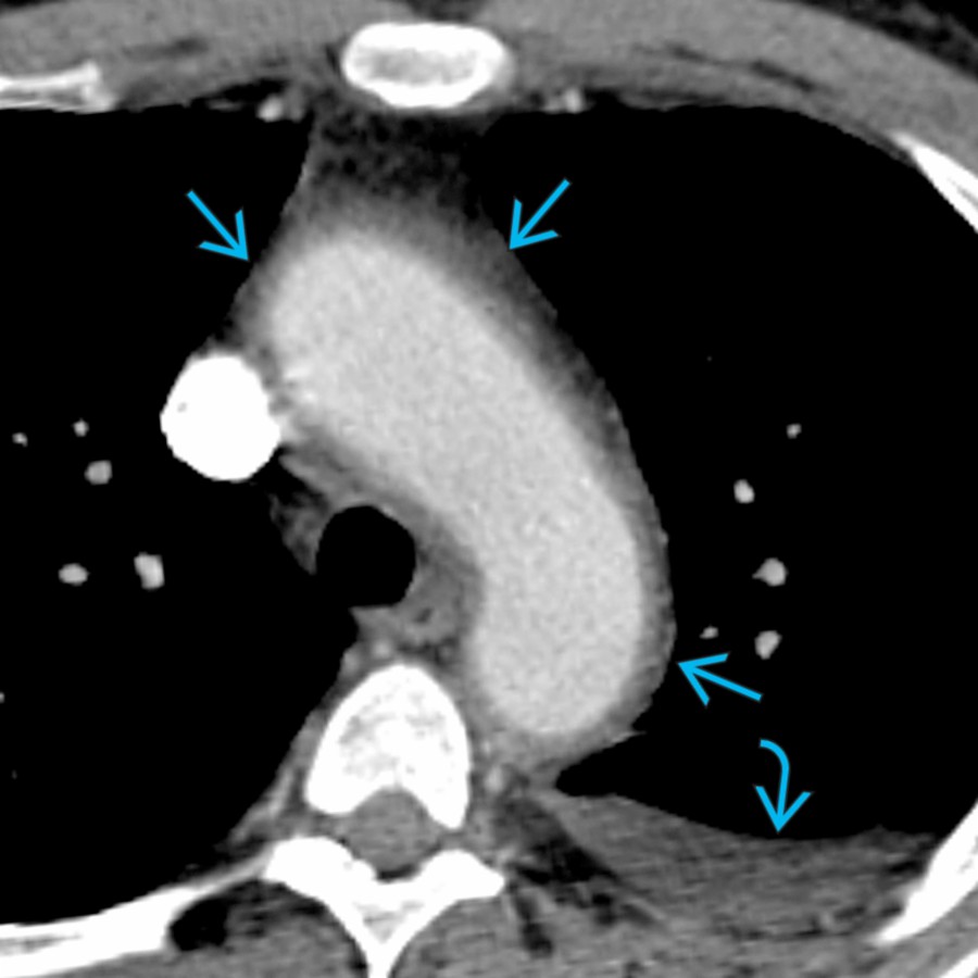 Axial CTA in a patient with GCA shows diffuse arterial wall thickening  and stranding of the periaortic fat. Note the reactive left pleural effusion .