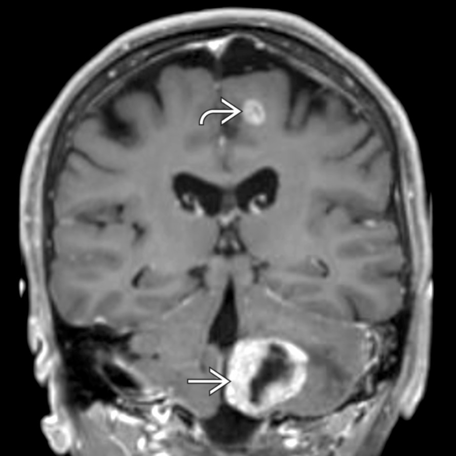 Coronal T1 C+ MR demonstrates a partly cystic, partly solid enhancing mass in the left cerebellar hemisphere  with surrounding vasogenic edema. A 2nd enhancing mass in the left frontal lobe  increases suspicion for metastatic disease in this patient with lung cancer (confirmed histologically).