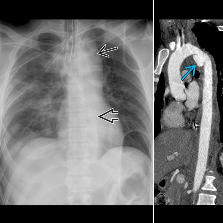 AP radiograph (left) shows abnormal soft tissue in the superior mediastinum   that obscures the normal aortic contour and displaces the trachea to the right. Additionally, there is widening of the paravertebral stripe . Coronal CT shows a traumatic aortic pseudoaneurysm at the aortic isthmus   with surrounding mediastinal and periaortic hematoma.