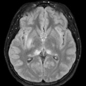 Axial FLAIR MR in a 10-year-old with acute myelin oligodendrocyte glycoprotein antibody-associated disease (MOGAD) shows characteristic thalamic , basal ganglia , hypothalamic , and insular cortex  hyperintense lesions. The hypothalamic lesions are relatively subtle but correlated clinically with lethargy and hypothalamic symptoms and signs.