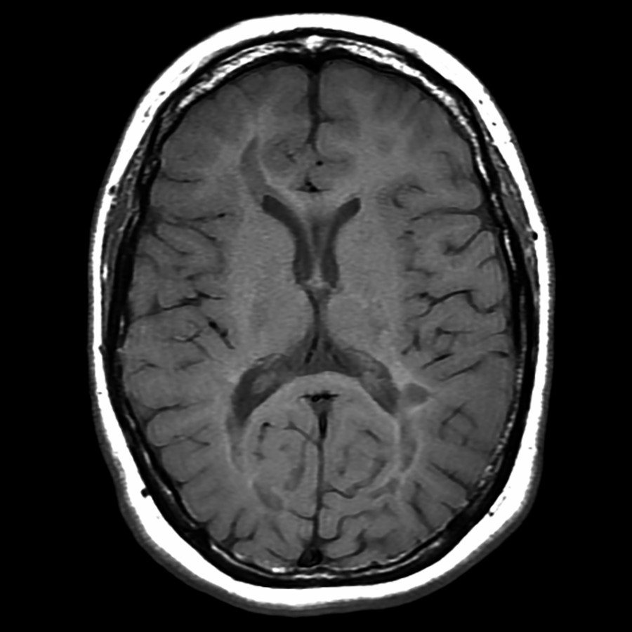 Axial T1 MR in the same patient reveals fairly extensive hypointensity within the demyelinating lesions, implying chronic disease with white matter axonal destruction (black holes).