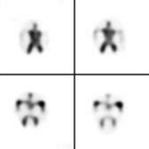 Axial SPECT in the same patient is shown. NPH is confirmed by visualization of significant ventricular activity at 24 hours .