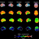 PET scan with stereotaxic surface projections in the same patient is shown. The top row is the reference map. The 2nd row illustrates glucose metabolism in elderly normal controls (n = 27). The 3rd row is the patient's glucose metabolism map. The 4th row is the Z-score map. The glucose metabolism  and Z-score maps  show markedly reduced metabolism in both frontal lobes. (Courtesy N. Foster, MD.)