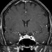 Coronal T1 C+ FS MR obtained after dynamic contrast-enhanced imaging shows the pituitary gland  enhances uniformly. This is physiologic pituitary hyperplasia as a response to hypothyroidism and does not represent an adenoma.