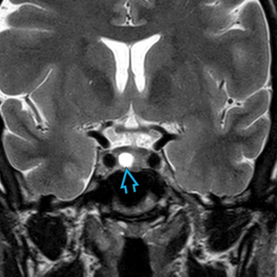 Coronal T2WI MR shows a cystic microadenoma  in the right pituitary gland. Microadenomas may be asymptomatic or may present with abnormal endocrine values, commonly elevated prolactin. When cystic, microadenomas mimic benign cysts, such as Rathke cleft cysts.