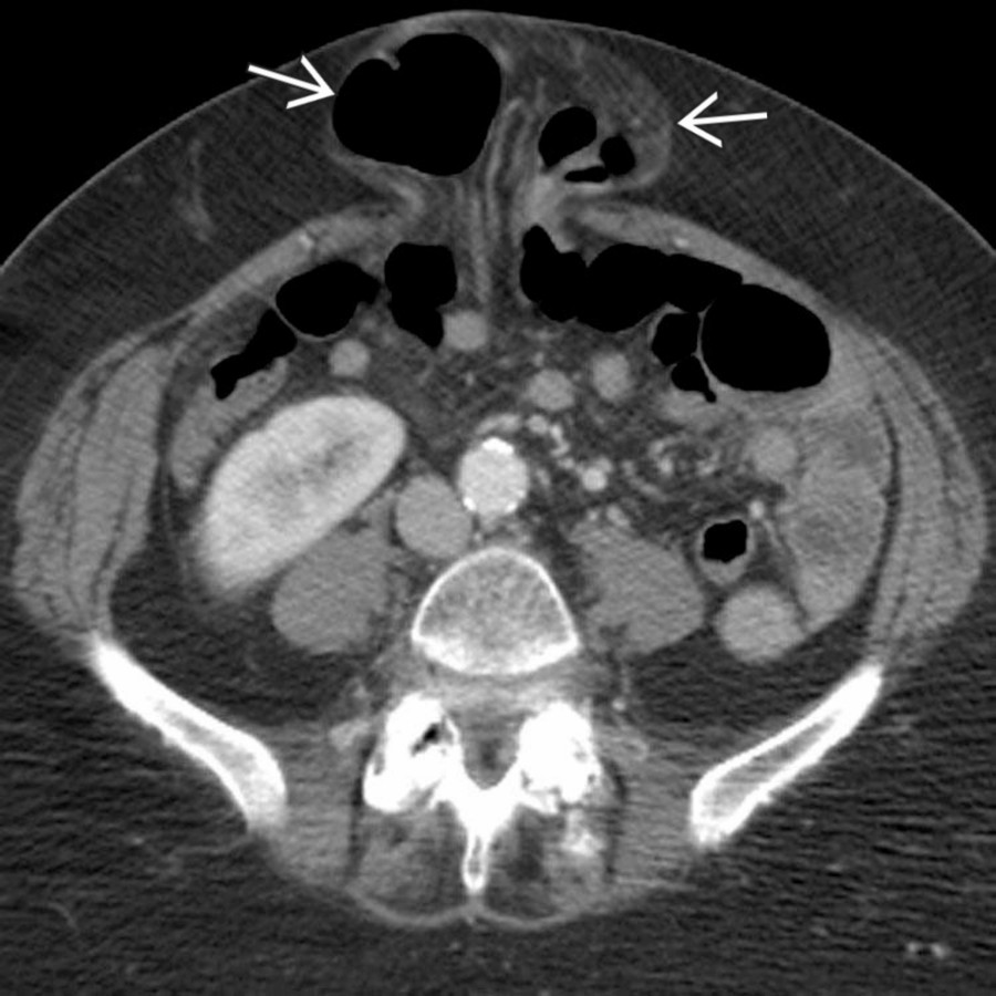 Axial CECT demonstrates protrusion of a portion of the transverse colon and omental fat through a defect in the anterior abdominal wall in the midline, representing an umbilical hernia . There is no sign of colonic obstruction nor infarction of the herniated fat, which are 2 of the common complications of abdominal wall hernias.