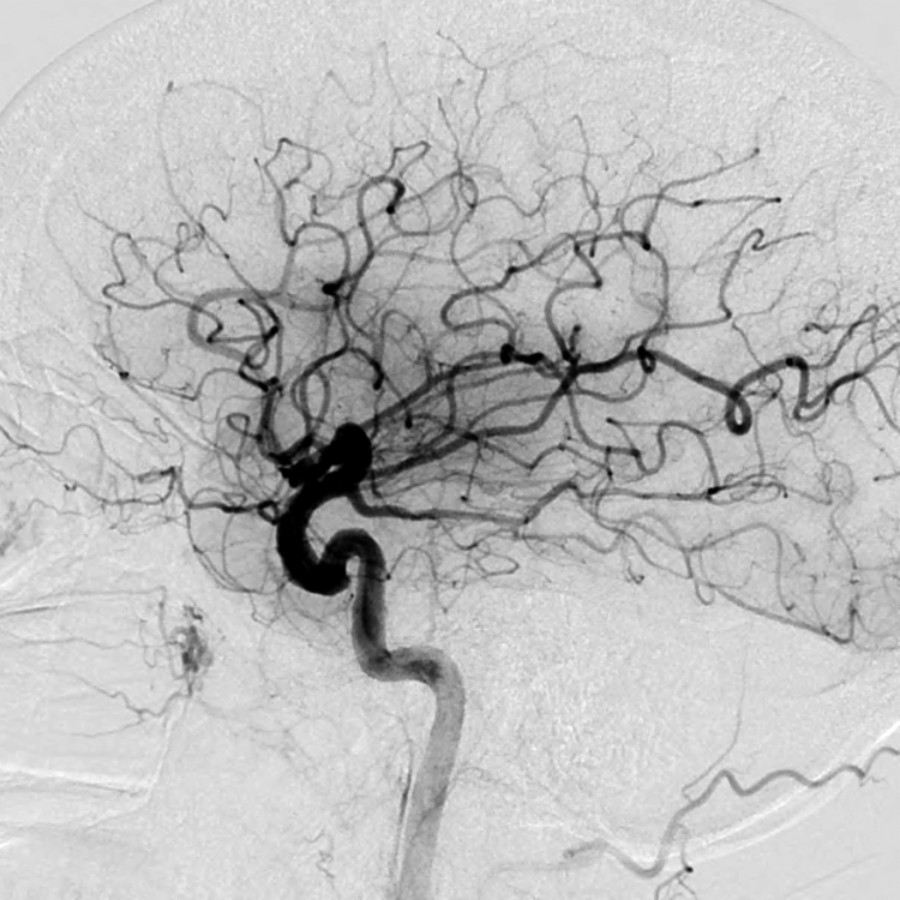 Lateral DSA from the left ICA demonstrates complete restoration of flow to the left ICA territory [thrombolysis in cerebral ischemia (TICI) 3]. This was obtained after 1 pass with the Solitaire 4 x 40-mm device.