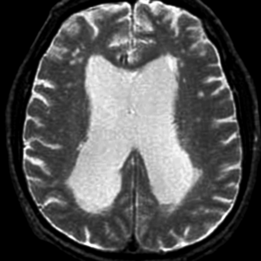 Axial T2WI MR shows ventricles dilated out of proportion to sulcal enlargement. Periventricular deep white matter lesions are also present.