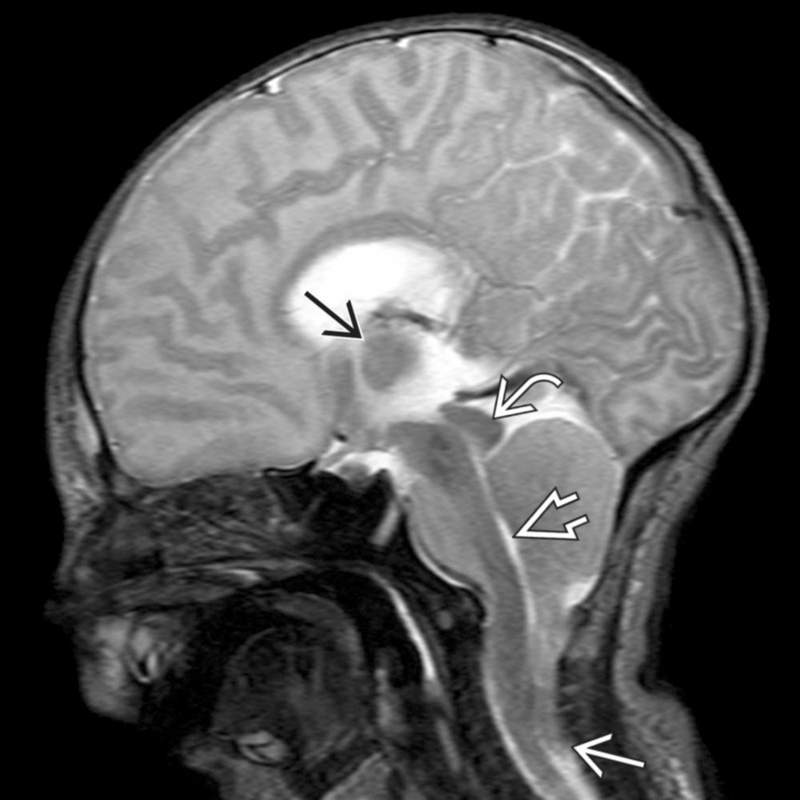 Sagittal T2 MR shows a small posterior fossa with extension of the cerebellar peg  through the foramen magnum to the level of C6. The cervicomedullary junction and 4th ventricle  are low-lying and there is mild tectal beaking   and moderate prominence of the massa intermedia .