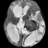 Axial T2 MR shows a large intraventricular mass coinciding with the left lateral choroid plexus glomus . The mass has decreased T2 signal, which may represent Ca⁺⁺ or blood products. There is obstructive hydrocephalus, which is common in choroid plexus tumors.