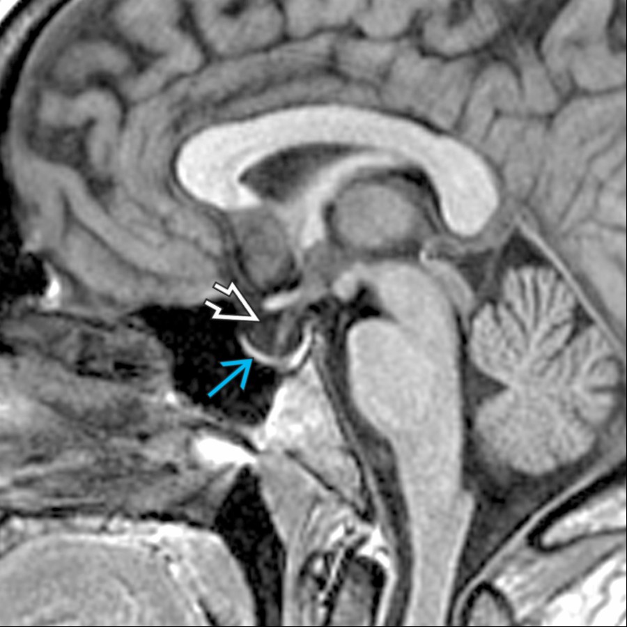 Sagittal T1 MR shows a partially empty sella  in this 28-year-old woman with seizures. Note the thinned pituitary gland  along the sellar floor. The empty sella was incidental in this case but may be associated with idiopathic intracranial hypertension.