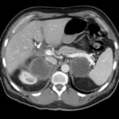 Staging CECT in a 66-year-old man with metastatic lung carcinoma shows large, bilateral, necrotic adrenal metastases . The clinical history and an enhancing rind  prevent an erroneous diagnosis of benign adrenal cysts.