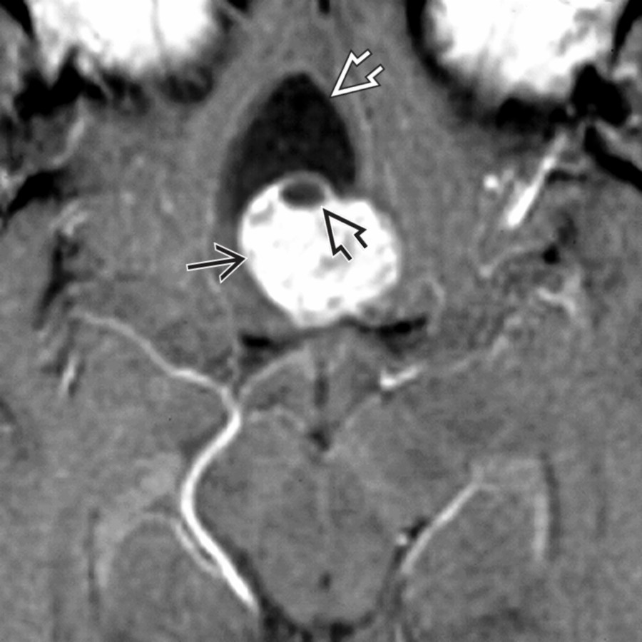 Axial T1 C+ MR shows 2 neoplasm-associated cysts: A large trapped perivascular space  caused by a pituitary macroadenoma  and a small intratumoral cyst  within the adenoma.