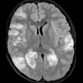 Axial FLAIR MR shows large, confluent regions of hyperintense signal  in the periventricular and subcortical WM in a 14 year old who presented with neck stiffness, fatigue, and seizures.