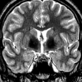 Coronal T2WI MR in a patient with classic PKAN shows the classic eye of the tiger sign with small foci of ↑ T2 signal in the medial globi pallidi  surrounded by abnormal pallidal hypointensity.