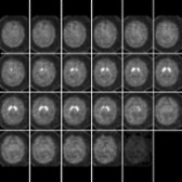 Axial I-123 Ioflupane SPECT images of the same patient from superior  to inferior  demonstrate the full appearance of caudate heads and putamen.