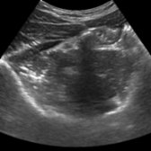 Transverse grayscale ultrasound of the right lower abdomen in the same case shows that the distal psoas muscle has diminished in size. It rests on the medial portion of the iliacus muscle; the latter is a flat muscle that fills the iliac fossa. Both continue inferiorly together.