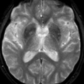 Axial T2* GRE MR shows no evidence for abnormal iron accumulation in the striatum, another location in which iron is commonly found in PD.