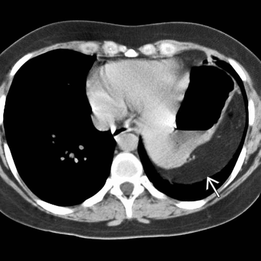 Axial NECT shows elevation of the left hemidiaphragm   without focal bulge or eventration. The abdominal contents do not fall dependently but are suspended by the intact diaphragm.