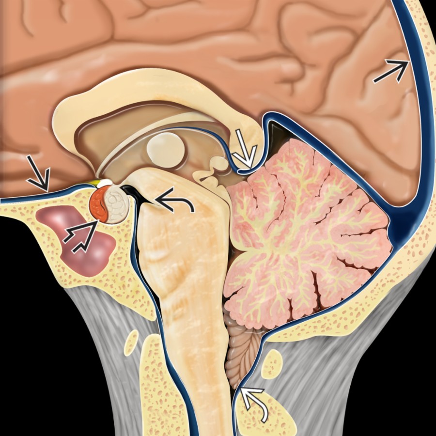 Graphic shows IH with distended dural sinuses  and enlarged pituitary  and herniated tonsils . Central brain descent causes midbrain slumping, inferiorly displaced pons, closed pons-midbrain angle , and splenium depressing ICV/vein of Galen junction .